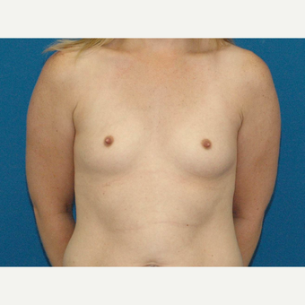 30 year old woman treated with Breast Augmentation before 3266690