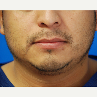 35-44 year old man treated with Hair Transplant before 3010018