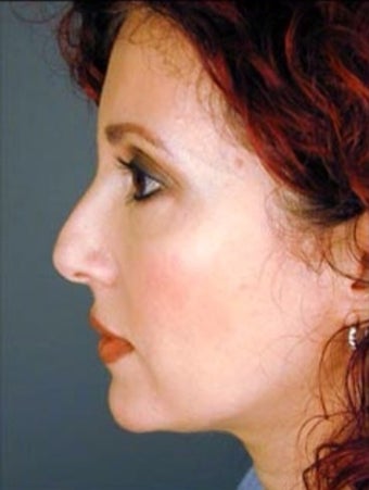 Female Primary Rhinoplasty 977148