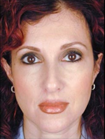 Female Primary Rhinoplasty before 977148