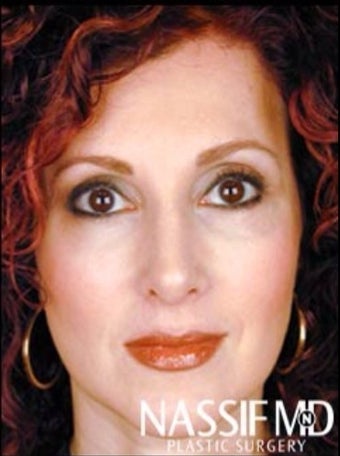 Female Primary Rhinoplasty after 977148