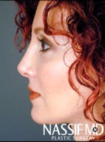 Female Primary Rhinoplasty 977148