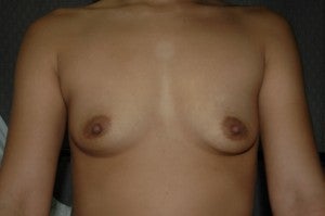 Bilateral silicone gel submuscular augmentation. 300cc moderate profile. Incision under breast. before 1410404