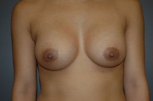Bilateral silicone gel submuscular augmentation. 300cc moderate profile. Incision under breast. after 1410404