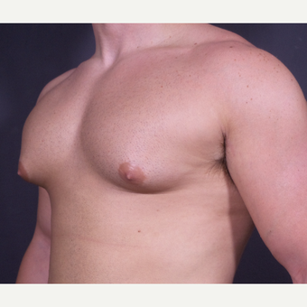 18-24 year old man treated with Male Breast Reduction before 3101097