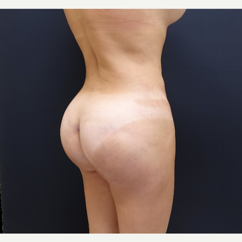 35-44 year old woman treated with 548cc Butt Implants for her Butt Lift after 3235667