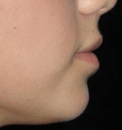 23 year old woman treated with Juvederm in Lips 3251531