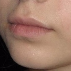 23 year old woman treated with Juvederm in Lips before 3251531
