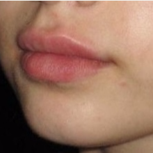 23 year old woman treated with Juvederm in Lips after 3251531