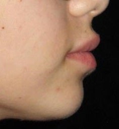 23 year old woman treated with Juvederm in Lips 3251531
