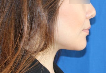 Lip Implant 944166