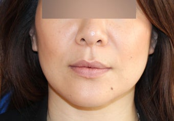 Lip Implant before 944166