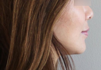 Lip Implant 944166