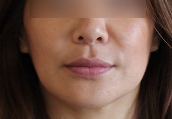 Lip Implant after 944166