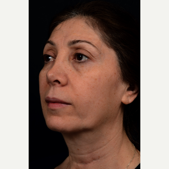 Fat Transfer, Facelift, Thermitight to the Neck before 3333447
