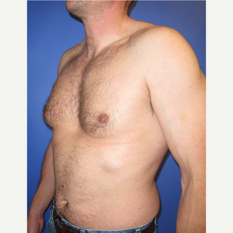 35-44 year old man treated with Male Breast Reduction before 3098498