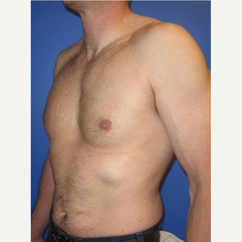 35-44 year old man treated with Male Breast Reduction after 3098498