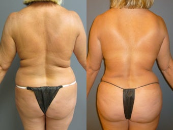 48 year old female present for a Brazilian Butt Lift before 943922