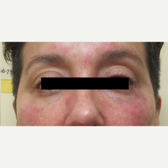 35-44 year old woman treated with Belotero after 3812944