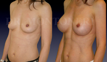 Breast implant before 1123295