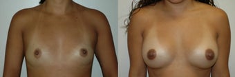 Breast Augmentation with Implants before 1271889