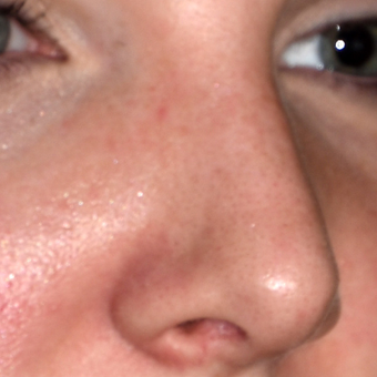 25-34 year old woman treated with Rhinoplasty before 3184666