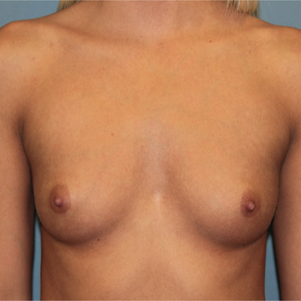 28 year old has Breast Augmentation to improve size and symmetry before 3465194
