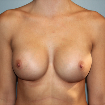 28 year old has Breast Augmentation to improve size and symmetry after 3465194