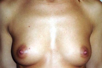 38 y.o. woman, caucasian, weight 48 kg, 1,70 height, with 2 cup size breasts, requesting 1 cup size increase before 750816