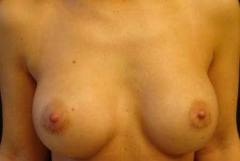 38 y.o. woman, caucasian, weight 48 kg, 1,70 height, with 2 cup size breasts, requesting 1 cup size increase after 750816
