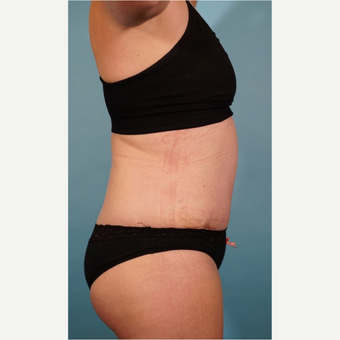 35-44 year old woman treated with Tummy Tuck after 3016676