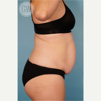 35-44 year old woman treated with Tummy Tuck before 3016676