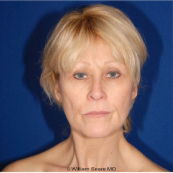 Cheek Augmentation with Natural Fat Transfer Long - Term Results before 3104866