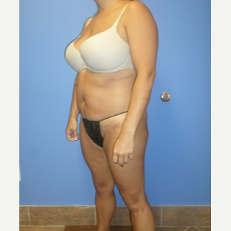 35-44 year old woman treated with Weight Loss after 3370158