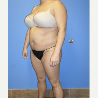 35-44 year old woman treated with Weight Loss before 3370158