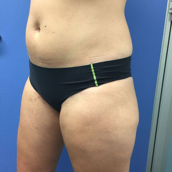25-34 year old woman treated with Liposuction before 3415633