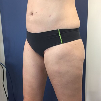 25-34 year old woman treated with Liposuction after 3415633