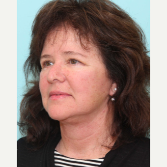 Lower Face and Neck Lift with Neck Liposuction and Upper and Lower Lid Blepharoplasty after 3446851