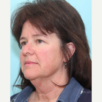 Lower Face and Neck Lift with Neck Liposuction and Upper and Lower Lid Blepharoplasty before 3446851