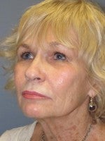 65-74 year old woman treated with Neck Lift before 3103925