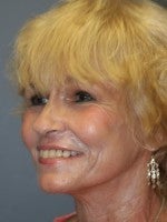 65-74 year old woman treated with Neck Lift after 3103925