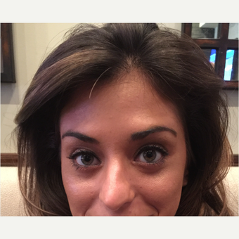 25-34 year old woman treated with Botox after 3822597