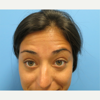 25-34 year old woman treated with Botox before 3822597