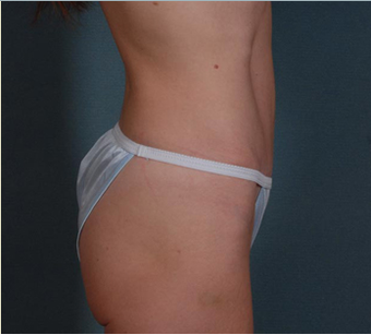 Mini Tummy Tuck after 1382426