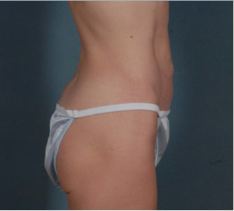 Mini Tummy Tuck before 1382426
