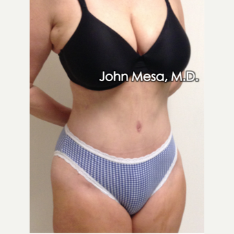 tummy Tuck (Brazillian Tummy Tuck) after 1697351