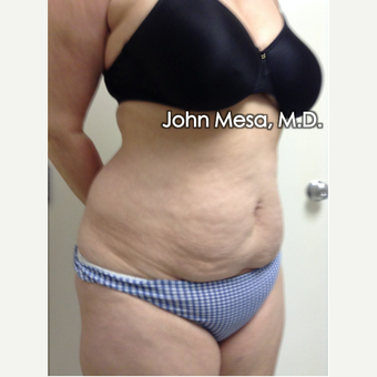 tummy Tuck (Brazillian Tummy Tuck) before 1697351