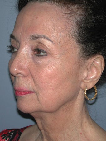 Chin Surgery on 65-year-old 841898