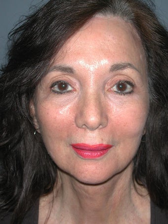 Chin Surgery on 65-year-old after 841898