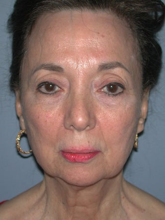 Chin Surgery on 65-year-old before 841898